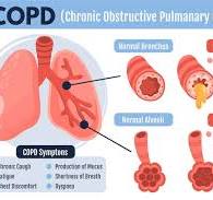 Evolving Guidelines: Reassessing the Role of Long-Acting Beta-Agonists with Inhaled Corticosteroids in COPD Management